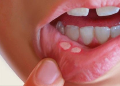 آفت دهان و راه‌های درمانی آن در طب سنتی