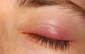 درمان گل‌مژه چشم به کمک راهکارهای طب سنتی