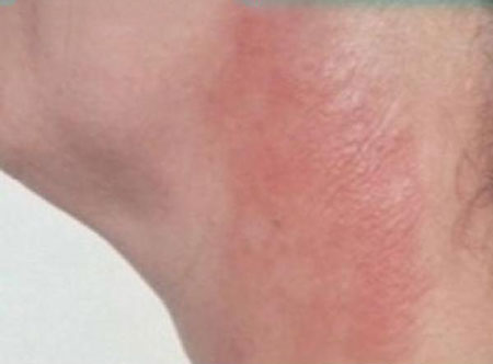 راهکار طب سنتی برای درمان عرق‌سوز