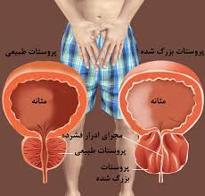 درمان بیماری پروستات در طب سنتی