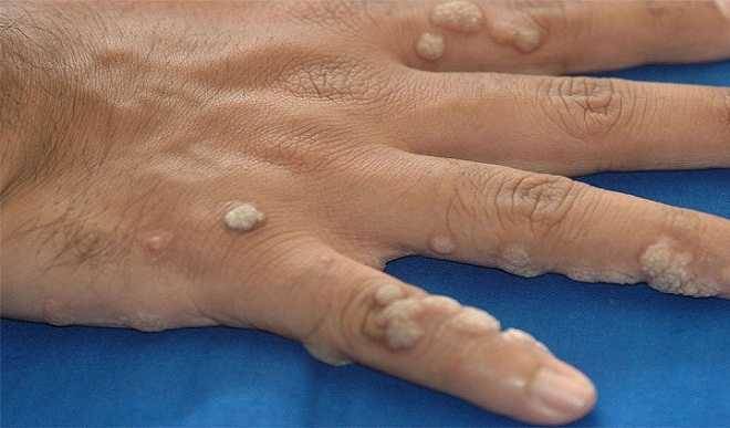 به کمک راهکارهای طب سنتی، زگیل خود را از بین ببرید.